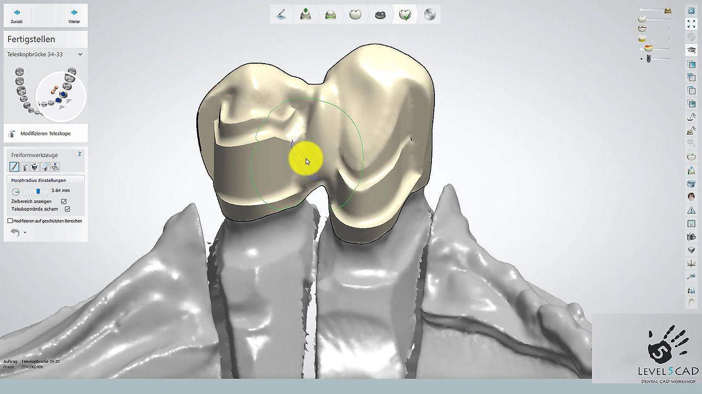 3Shape Dental System 2016: Die Kronenkonstruktion mit Umlauf und Interlock
